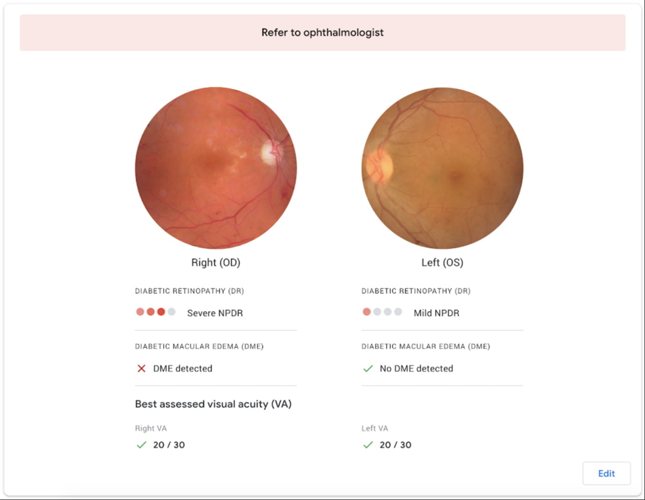 Die KI analysiert die Augenaufnahmen auf Auffälligkeiten, die auf eine Krankheit hinweisen. Entdeckt sie diese, verweist sie auf einen Augenarzt. Bild: Google