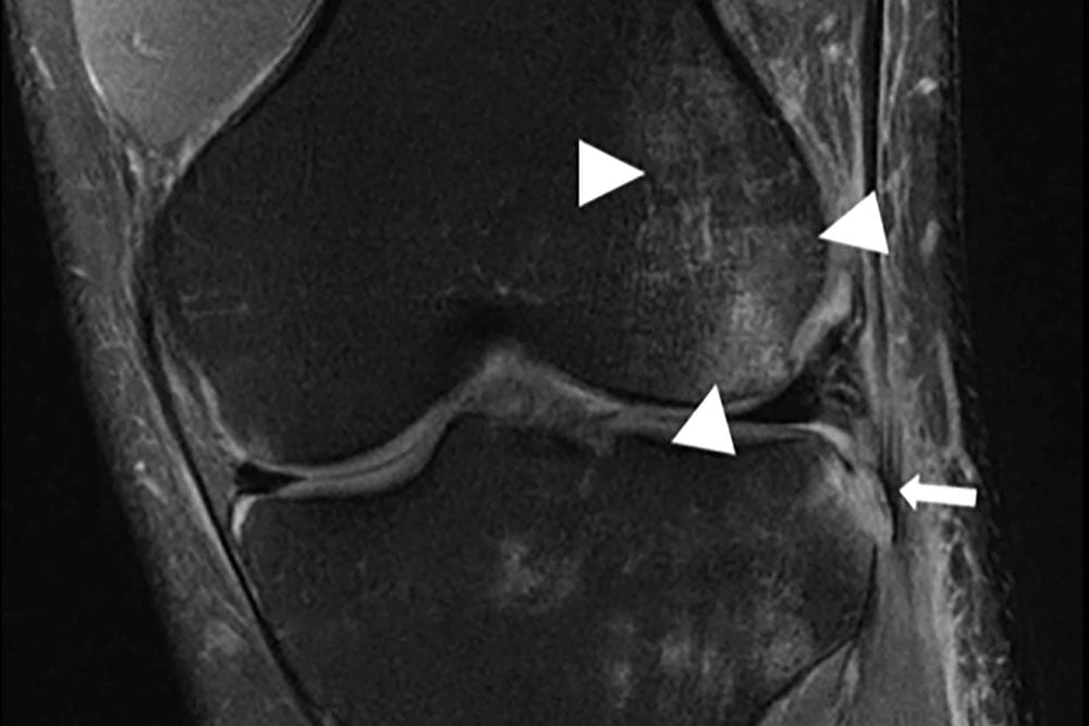 Von KI rekonstruiertes Knie-MRT-Bild