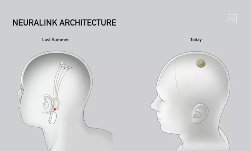 Im Vergleich zur ersten Version im vergangenen Sommer ist der Neuralink-Chip kompatker geworden. | Bild: Neuralink / Screenshot